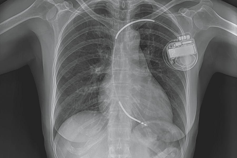Röntgenbild eines Oberkörpers mit eingesetztem Herzschrittmacher